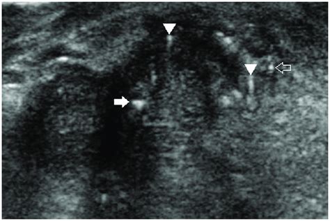 A 52 Year Old Woman With Papillary Thyroid Carcinoma Longitudinal