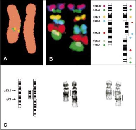 Figure 2 From Wolf Hirschhorn Syndrome Whs Unbalanced