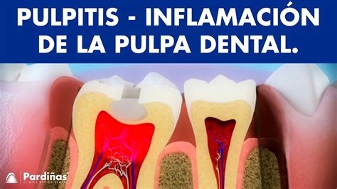 Qué es una pulpitis Cuáles son los síntomas de una inflamación de la