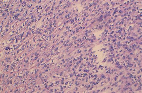 Histological Aspects Of Embryonic Paratesticular Rhabdomyosarcoma ×20