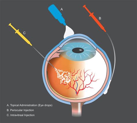 Intravitreal Injections At Lehigh Eye Specialists Lehigh Eye Specialists