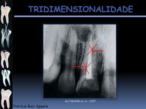 Ppt Obtura O Do Sistema De Canais Radiculares Powerpoint