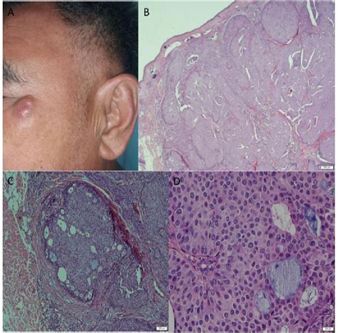 Figure From Endocrine Mucin Producing Sweat Gland Carcinoma Newly