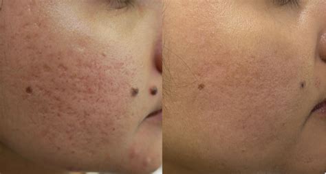 Co Laser Resurfacing For Acne Scars Cutis Dermatology