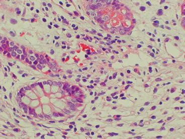 Small Bowel Transplantation | Abdominal Key