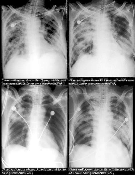 Ventilator Associated Pneumonia Xray