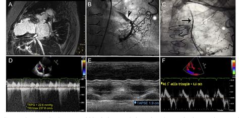 Figure From Percutaneous Venous Pulmonary Artery Extracorporeal