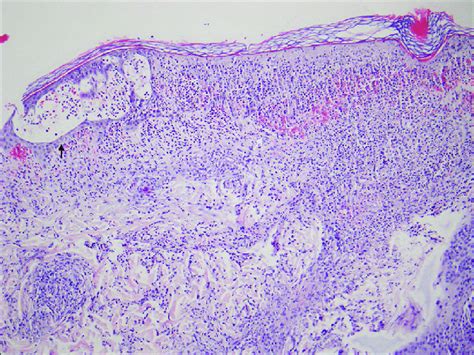 Skin Biopsy Medium Magnification H And E Staining Skin Biopsy Reveals Download Scientific