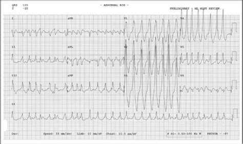 Ecg Diagnosis Wolff Parkinson White Syndrome The Permanente Journal