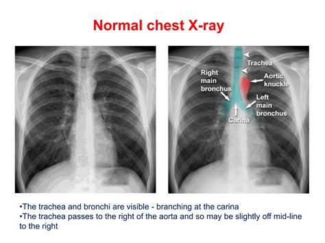 Chest Xrays Step By Step Approach Pptx