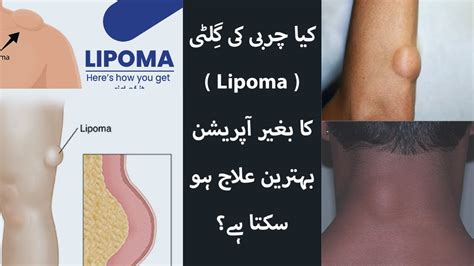 Best Treatment For Lipoma Lipoma Ka Behtreen Ilaj YouTube