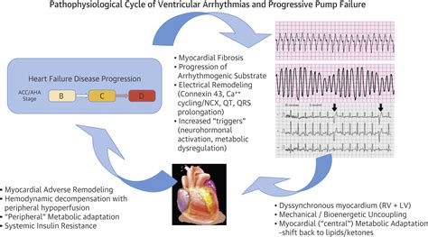 Management Of Ventricular Arrhythmias In Patients With Advanced Heart