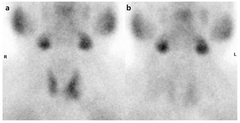 Dual Phase Tc 99m MIBI Planar Scintigraphy The Early Images A Show