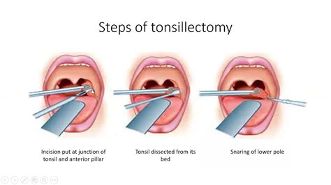 Tonsillectomy Ent Lecture Series Youtube