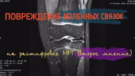БОЛЬ в левом колене при ПОВРЕЖДЕНИИ СВЯЗОК колена (СИНОВИТ) на ...