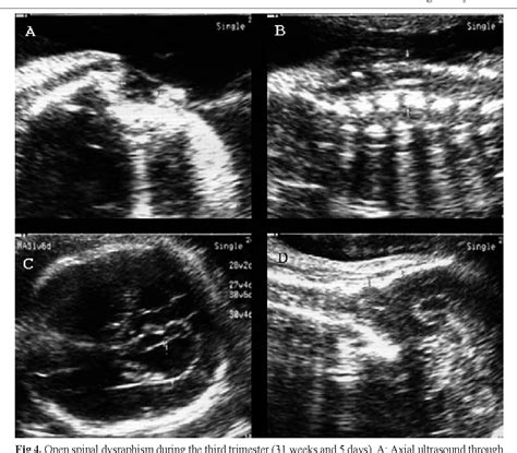 Figure 8 From Prenatal Ultrasound Diagnosis Of Neural Tube Defects