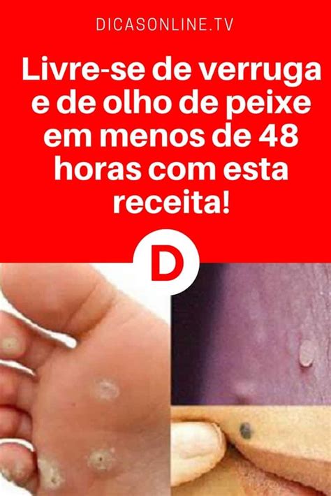 Olho De Peixe No Dedo Da Mão Como Tratar