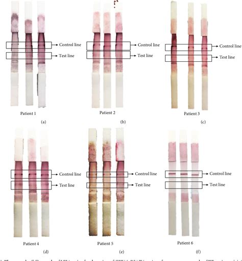 Figure From Lateral Flow Immunoassay For Naked Eye Detection Of