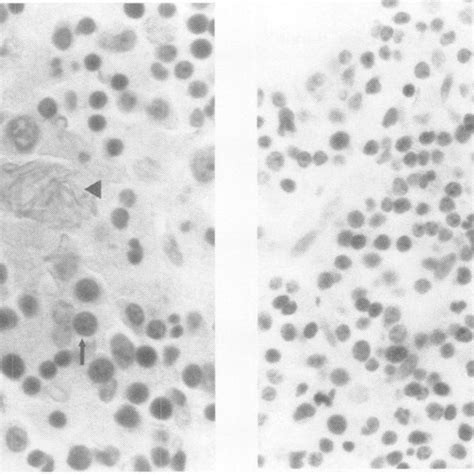 A Photomicrograph Of A Bone Marrow Biopsy Depicts Small Blood Vessels