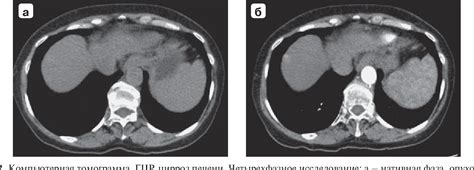 Challenges Of Hepatocellular Cancer Diagnosing In Computed Tomography