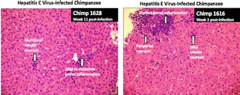 Histopathology Acute Hepatitis C Is Shown By Multifocal Lobular