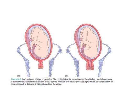 Obstetric emergencies | PPT