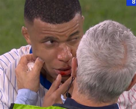 France Autriche fracture du nez opération pour Mbappé