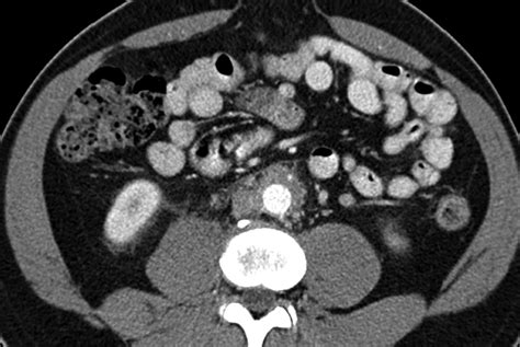 Radiology Of The Retroperitoneum Case Based Review Ajr