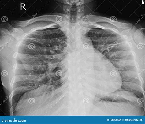 X-ray Chest LORDOTIC VIEW stock image. Image of bone - 138200539