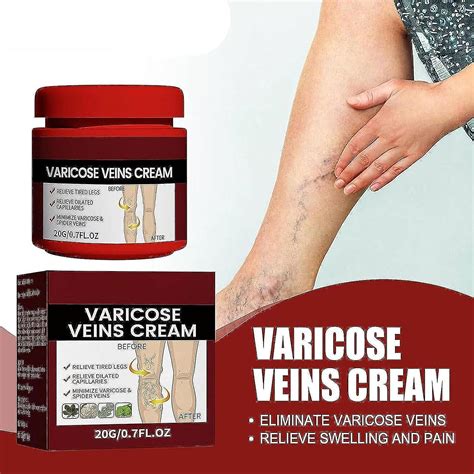 Cr Me Varices Traitement Des Varices Pour Les Jambes Varices Veines