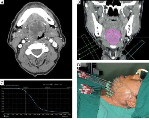 Figure 1 From The Efficacy Of Iodine 125 Interstitial Brachytherapy For The Treatment Of Locally