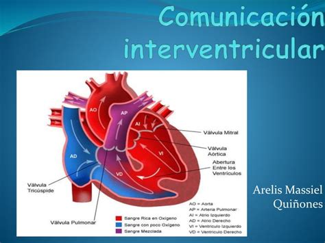 Comunicación Interventricular Ppt