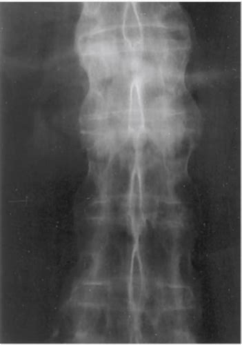 Lecture Immune Mediated Musculoskeletal Disorders In Adults Ii