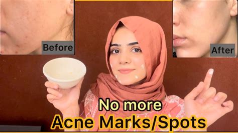 How To Remove Acne Marks Or Spots Best Easy Home Remedy For Acne