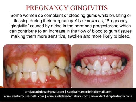 Sensitive Gums During Pregnancy Gingivitis And Pregnancy What You