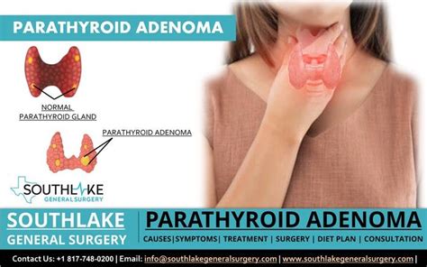 Parathyroid Adenoma Symptoms And Treatment Dr Valeria Simone Md General Surgery