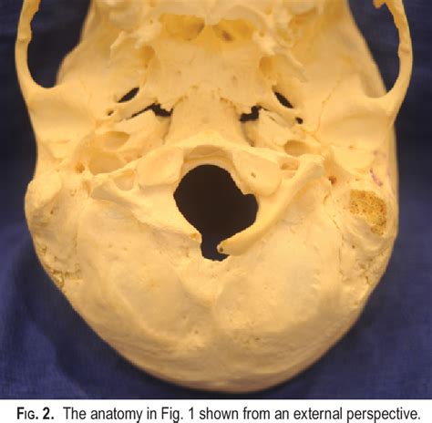 Figure 2 From Morphometry Of The Outlet Of The Foramen Magnum In Crania