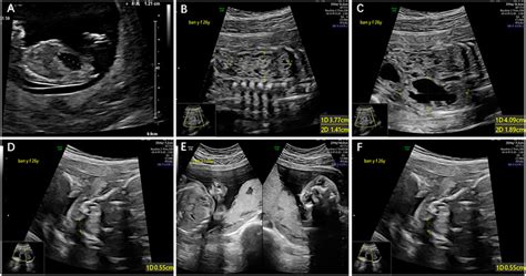 Frontiers Case Report Prenatal Diagnosis Of Ectrodactylyectodermal