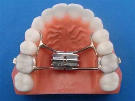 Everything You Need To Know About Palatal Expanders In Orthodontics