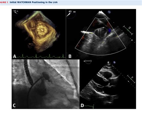 Figure 1 From A Case Of Delayed Hemorrhagic Effusive Constrictive