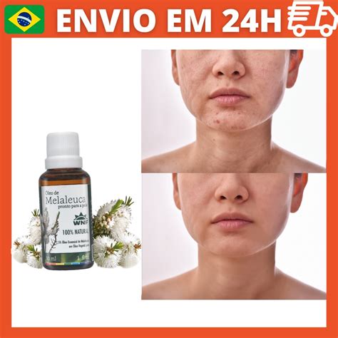 Oleo Essencial Melaleuca Pronto Para Pele Wnf Ml Diluido Em Oleo