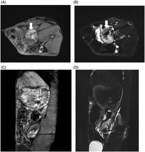 Immediate Efficacy Of Postoperative MR Guided MWA A 3D VIBE T1WI