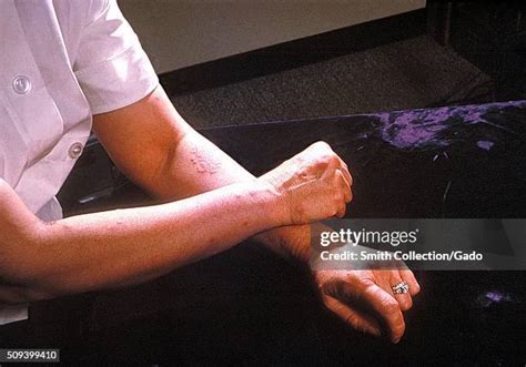 29 Erythema Nodosum Stock Photos High Res Pictures And Images Getty