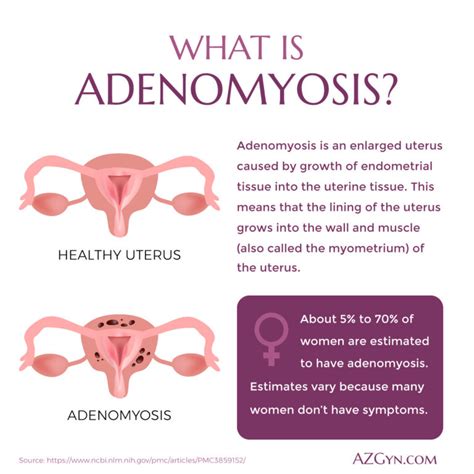 Adenomyosis Risk Factors Adenomyosis Causes And Symptoms