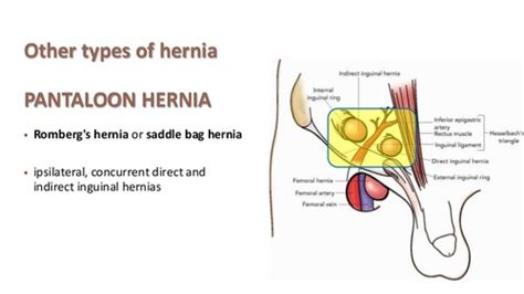 Pantaloon Hernia