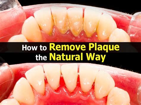 How to Remove Plaque the Natural Way