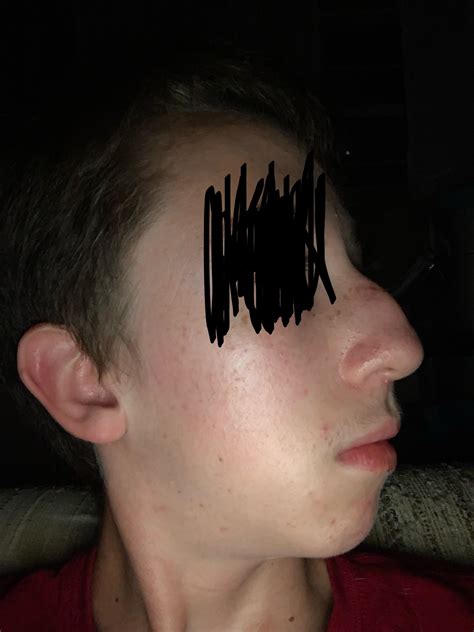 Broken nose: I’m 14 and a few years ago (maybe 5) my brother broke my ...