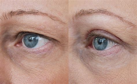 Upper And Lower Eyelid Surgery Melbourne Heidelberg Eye Clinic