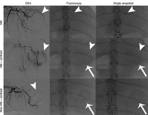 Images From Digital Subtraction Angiography Dsa Anteroposterior