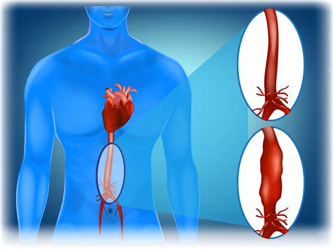 Aortic Aneurysm Repair | Apex Vascular